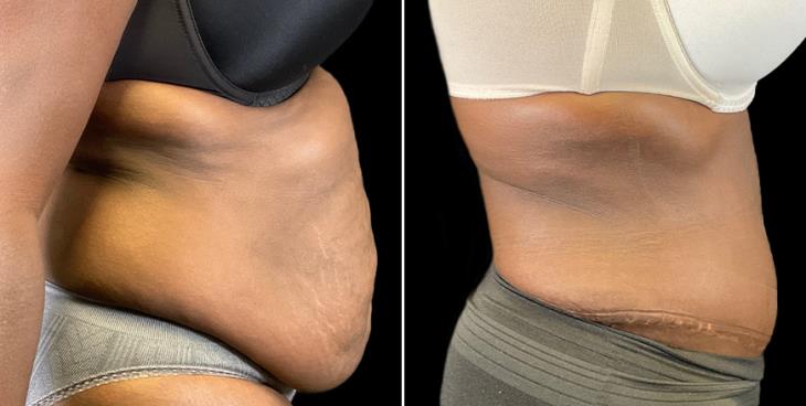 Results Of Tummy Tuck Surgery In Atlanta GA Side View