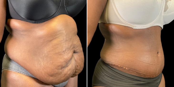 Results Of Tummy Tuck Surgery In Atlanta GA ¾ Right View