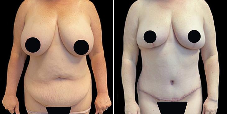 Before & After Tummy Tuck Surgery In Atlanta