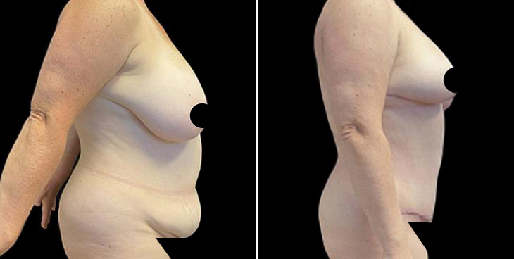 Results Of Tummy Tuck Surgery In Atlanta Right View