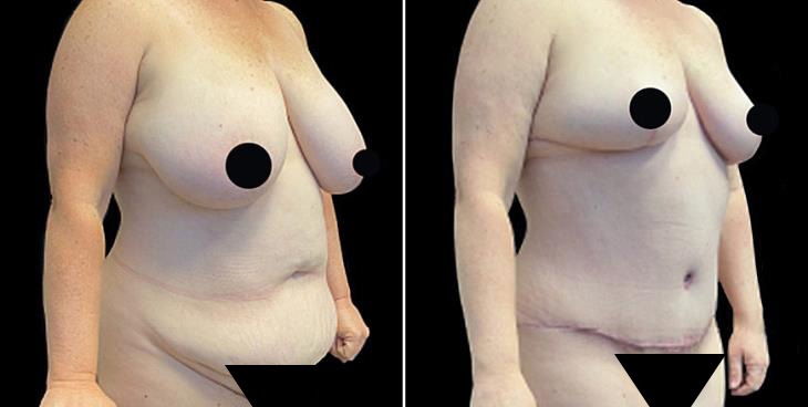 Before & After Tummy Tuck Surgery In Atlanta ¾ Right View