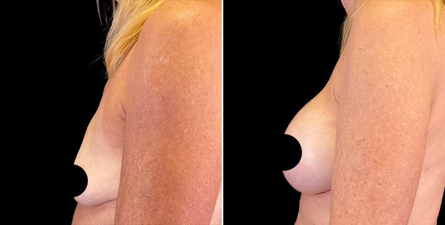 Breast Implant Results In Atlanta GA Left View