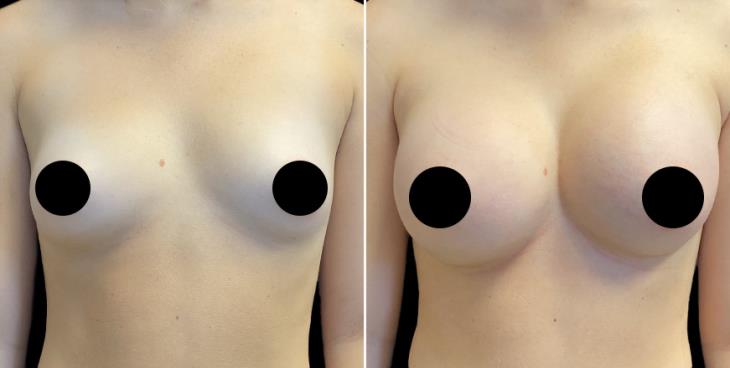 Atlanta GA Breast Implants Results