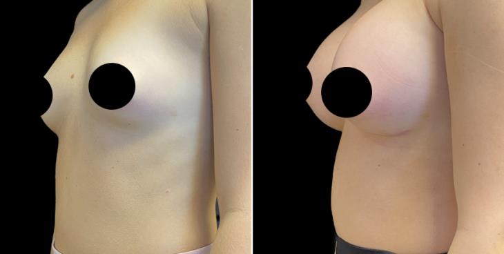 Atlanta GA Breast Implants Results ¾ Left View