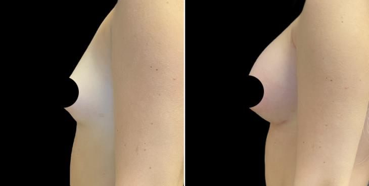 Atlanta GA Breast Implants Results Left View