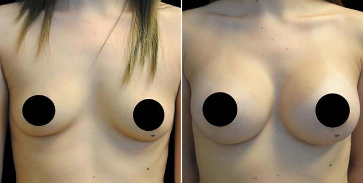 Before & After Breast Implants In Atlanta