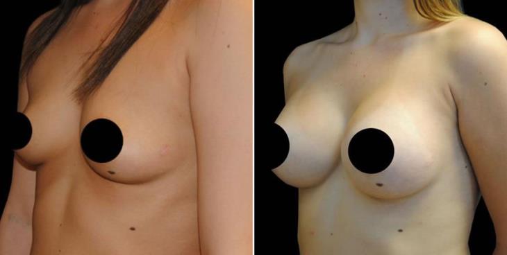 Before & After Breast Implants In Atlanta ¾ Left View