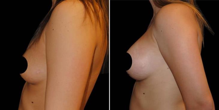 Before & After Breast Implants In Atlanta Left View